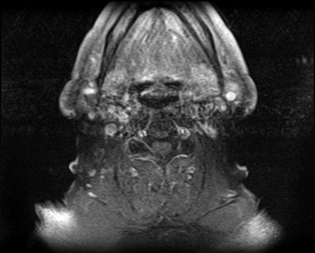 File:Non-Hodgkin lymphoma - parotid gland (Radiopaedia 71531-81890 Axial T1 C+ fat sat 7).jpg