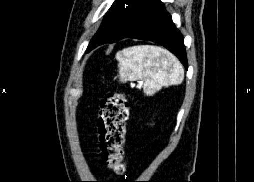 Non-syndromic pancreatic endocrine tumor (Radiopaedia 86958-103178 E 91).jpg