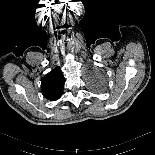 File:Non Hodgkin lymphoma in a patient with ankylosing spondylitis (Radiopaedia 84323-99621 Axial non-contrast 2).jpg