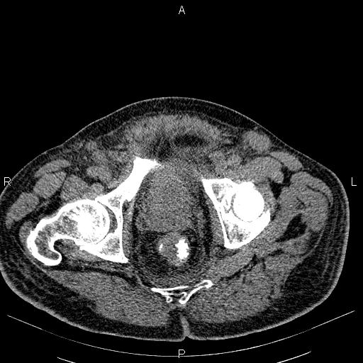 File:Non Hodgkin lymphoma in a patient with ankylosing spondylitis (Radiopaedia 84323-99621 Axial non-contrast 59).jpg