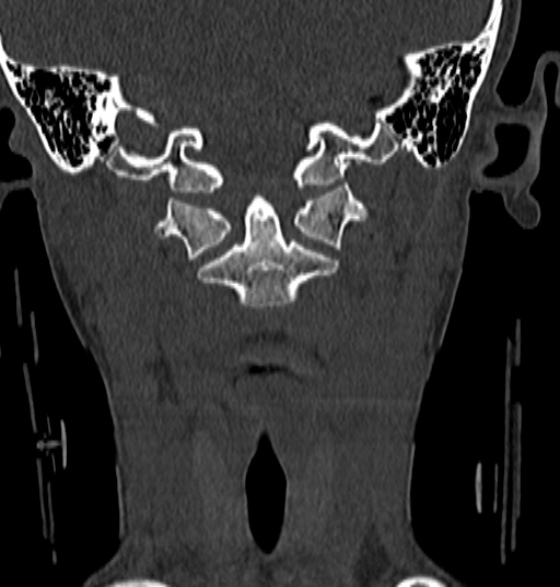 File:Normal CT cervical spine - 12-year-old (Radiopaedia 55352-61775 Coronal bone window 59).jpg
