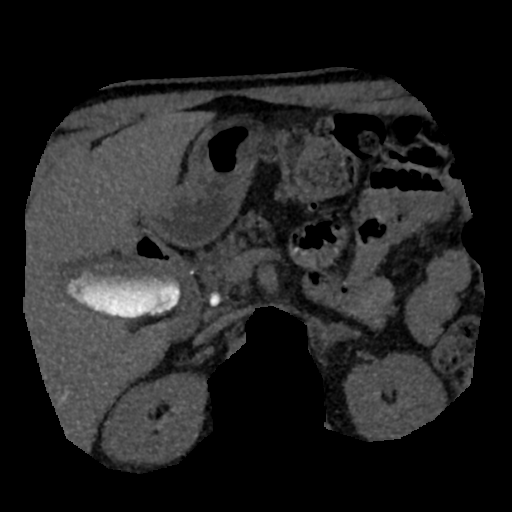 File:Normal CT intravenous cholangiogram (Radiopaedia 38199-40208 Axial IVC (MIP) 38).png