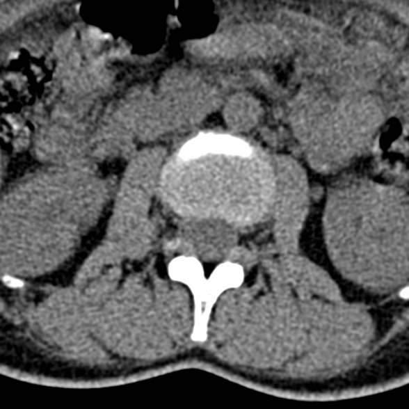 Normal CT lumbar spine (Radiopaedia 53981-60118 Axial non-contrast 39).jpg
