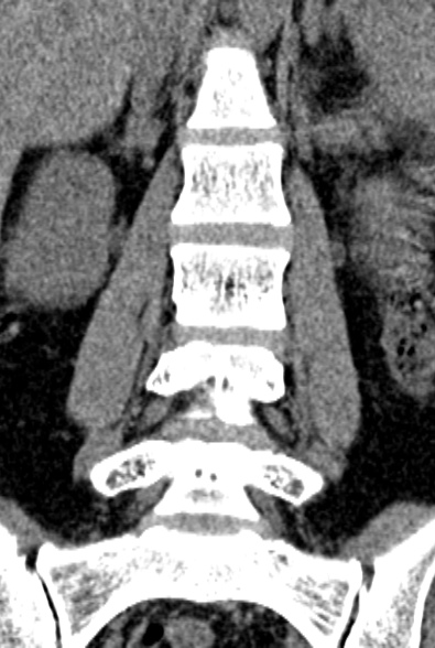 Normal CT lumbar spine (Radiopaedia 53981-60118 F 36).jpg