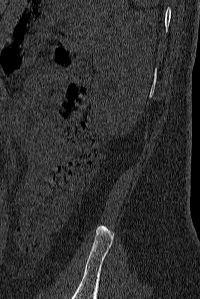 File:Normal CT lumbar spine (Radiopaedia 53981-60118 Sagittal bone window 106).jpg