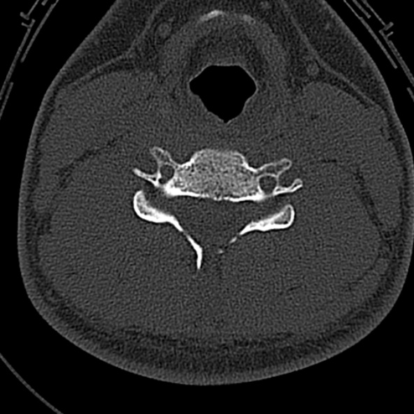 Normal CT of the cervical spine (Radiopaedia 53322-59305 Axial bone window 158).jpg