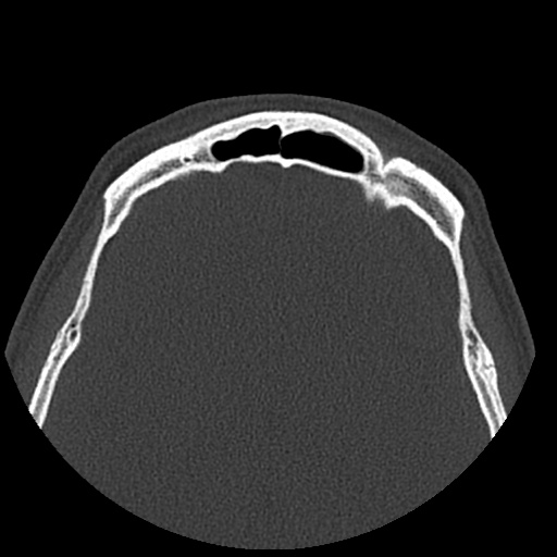 Normal CT paranasal sinuses (Radiopaedia 42286-45390 Axial bone window 24).jpg