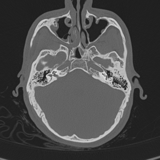 Normal CT skull (Radiopaedia 40798-43459 A 41).png
