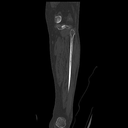 Normal CT tibia and fibula (Radiopaedia 51195-56848 Coronal non-contrast 46).jpg