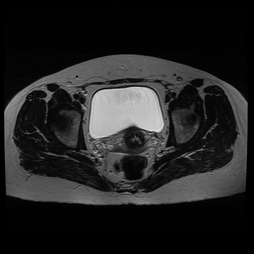 Normal MRI abdomen in pregnancy (Radiopaedia 88005-104548 Axial T2 35).jpg
