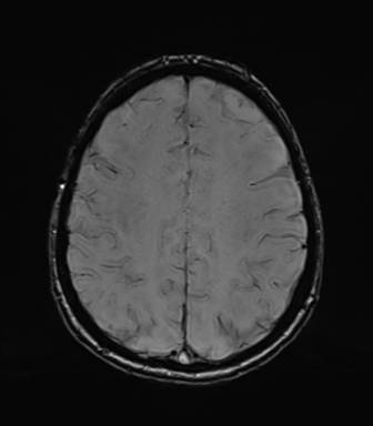 Normal brain MRI (TLE protocol) (Radiopaedia 40748-43405 Axial SWI 62).png