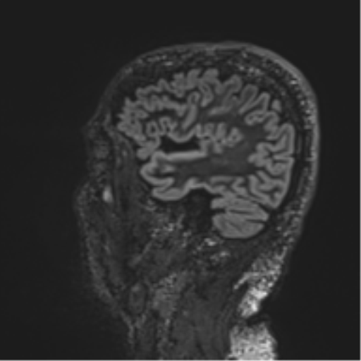 Normal brain MRI (non-focal epilepsy protocol) (Radiopaedia 53917-60040 Sagittal DIR 49).png