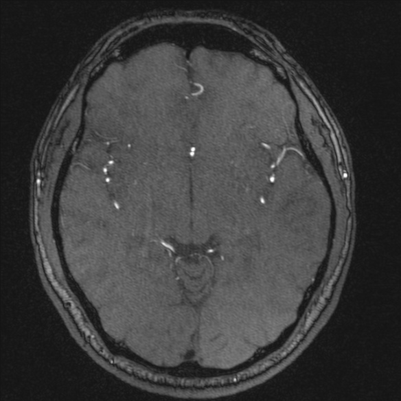 Normal brain MRI including MRA (Radiopaedia 48748-53763 Axial MRA 100).jpg