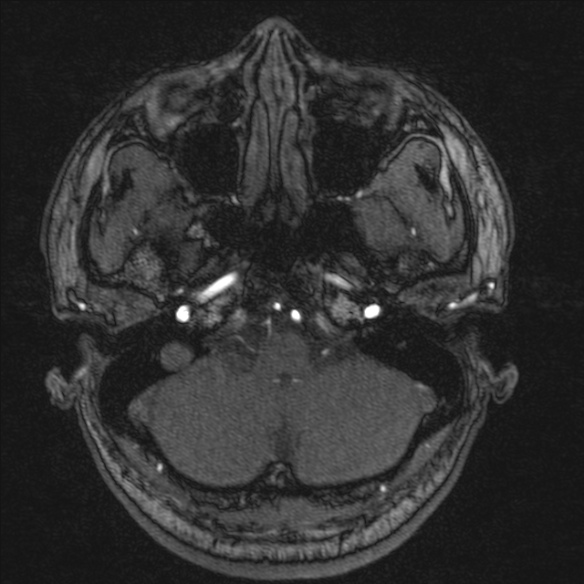 Normal brain MRI including MRA (Radiopaedia 48748-53763 Axial MRA 30).jpg