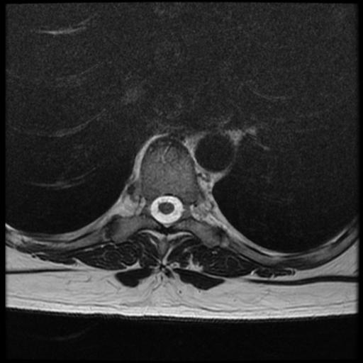 File:Normal cervical and thoracic spine MRI (Radiopaedia 35630-37156 H 22).png