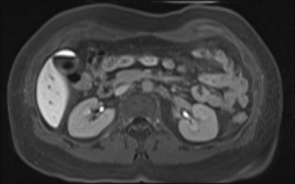 File:Normal hepatobiliary phase liver MRI (Radiopaedia 58968-66230 A 60).jpg