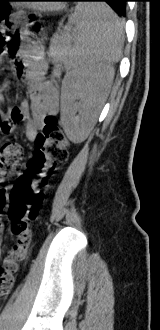 Normal lumbosacral CT (Radiopaedia 37923-39867 E 11).png