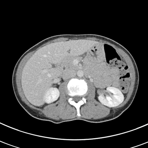 File:Normal multiphase CT liver (Radiopaedia 38026-39996 C 32).jpg