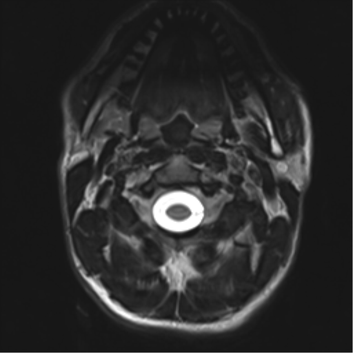 Normal trauma cervical spine (Radiopaedia 41017-43762 D 2).png