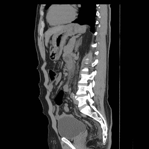 File:Obstructed kidney with perinephric urinoma (Radiopaedia 26889-27066 B 41).jpg