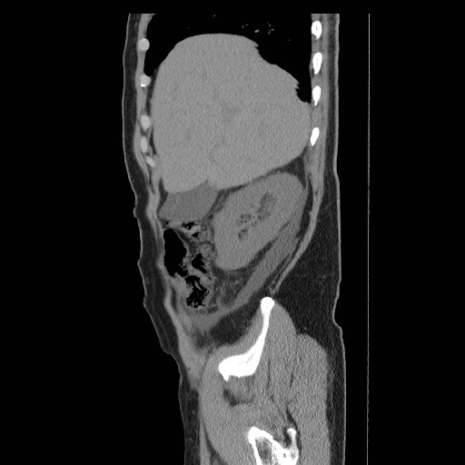 File:Obstructed kidney with perinephric urinoma (Radiopaedia 26889-27066 B 5).jpg