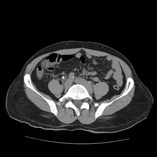 File:Obstructed kidney with perinephric urinoma (Radiopaedia 26889-27067 Axial non-contrast 28).jpg