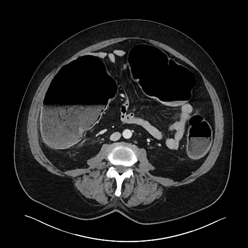 Obstructing sigmoid adenocarcinoma (Radiopaedia 58465-65619 A 92).jpg