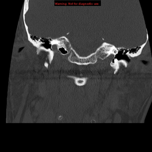 File:Occipital condyle fracture (Radiopaedia 18366-18208 Coronal bone window 3).jpg