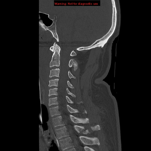 File:Occipital condyle fracture (Radiopaedia 18366-18208 Sagittal bone window 19).jpg