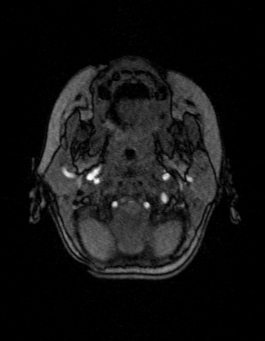 Occipital horn syndrome (Radiopaedia 14255-14129 MRA 12).jpg