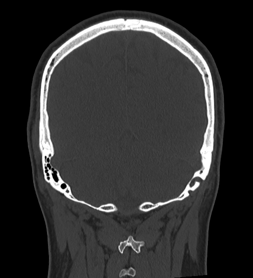 Occipital spur and Currarino type A atlas anomaly (Radiopaedia 87027-103285 Coronal bone window 111).jpg