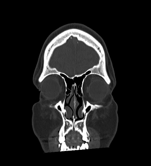 Occipital spur and Currarino type A atlas anomaly (Radiopaedia 87027-103285 Coronal bone window 34).jpg