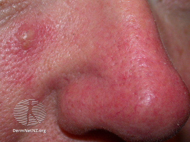 Rosacea Dermnet Nz Acne Red Face Nc Commons