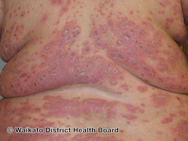 File:Severe psoriasis (DermNet NZ psoriasis-severe).jpg