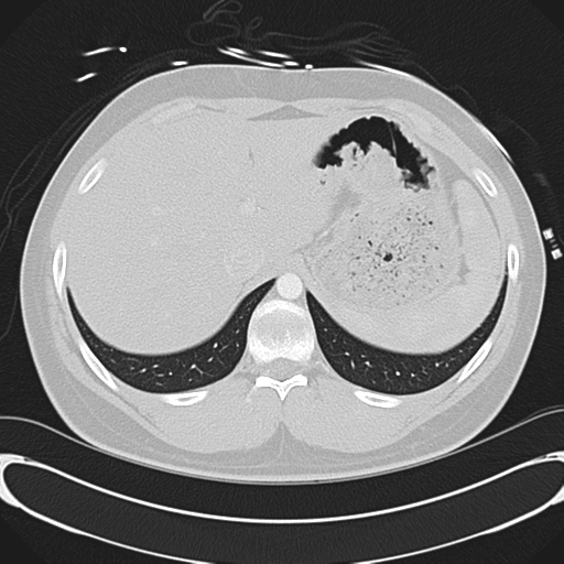File:'Bovine' aortic arch (Radiopaedia 33554-34637 Axial lung window 59).png