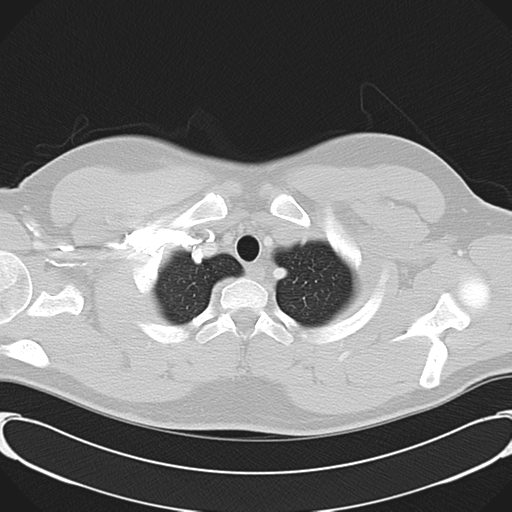 File:'Bovine' aortic arch (Radiopaedia 33554-34637 Axial lung window 8).png