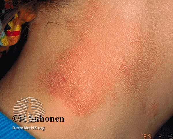 File:(DermNet NZ dermatitis-lichen-simplex-3122).jpg