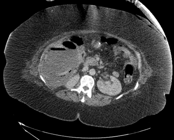 File:Abdominal abscess - pre and post percutaneous drainage (Radiopaedia 60209-67816 Axial 29).png