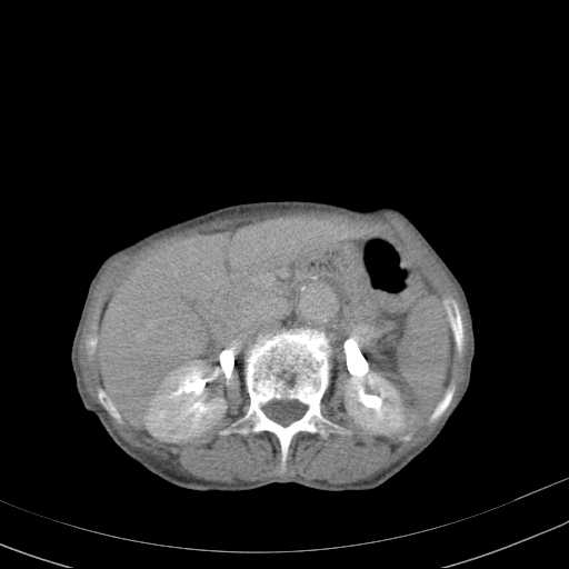 File:Abdominal aortic aneurysm (Radiopaedia 20827-20742 Axial C+ delayed 11).jpg