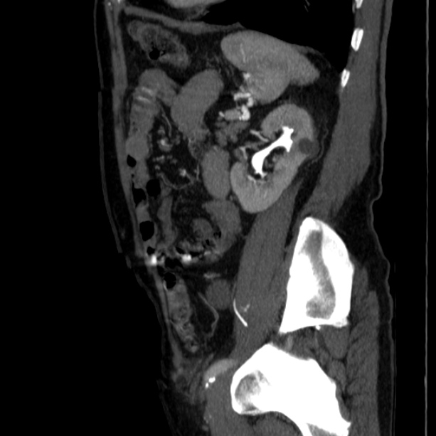 Abdominal aortic aneurysm (Radiopaedia 29248-29660 Sagittal C+ arterial phase 40).jpg