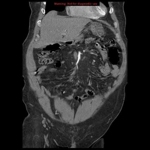 Abdominal aortic aneurysm (Radiopaedia 8190-9038 Coronal C+ arterial phase 32).jpg