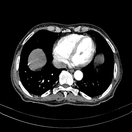Abdominal aortic aneurysm (Radiopaedia 83581-98689 Axial C+ arterial phase 10).jpg