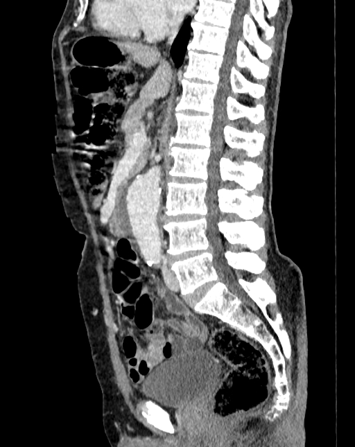 Abdominal aortic aneurysm (Radiopaedia 83581-98689 Sagittal C+ portal venous phase 47).jpg