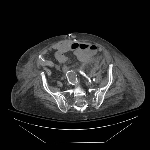 Abdominal aortic aneurysm - impending rupture (Radiopaedia 19233-19247 Axial non-contrast 124).jpg