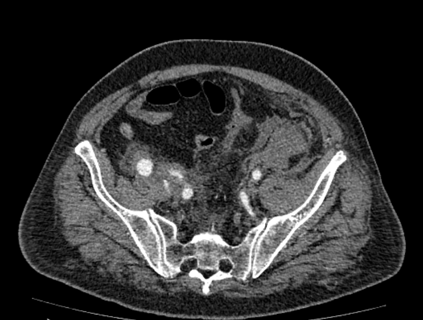 Abdominal aortic aneurysm rupture (Radiopaedia 54179-60362 Axial C+ portal venous phase 7).jpg