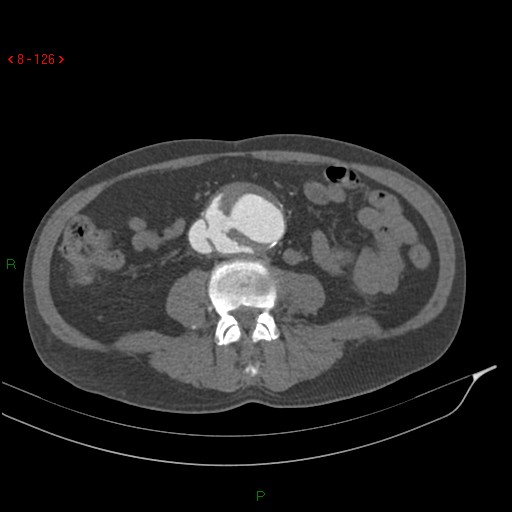 File:Abdominal aortic aneurysm rupture with aortocaval fistula (Radiopaedia 14897-14841 Axial C+ arterial phase 126).jpg