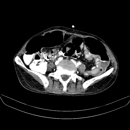File:Abdominal collection due to previous cecal perforation (Radiopaedia 80831-94320 Axial C+ portal venous phase 132).jpg
