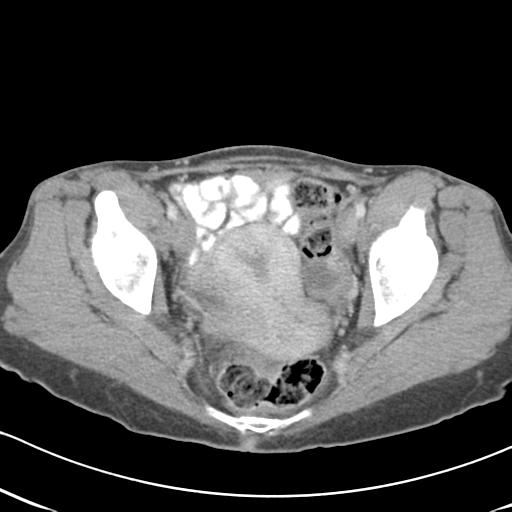 Abdominal desmoid tumor (Radiopaedia 41007-43740 Axial C+ portal venous phase 64).png