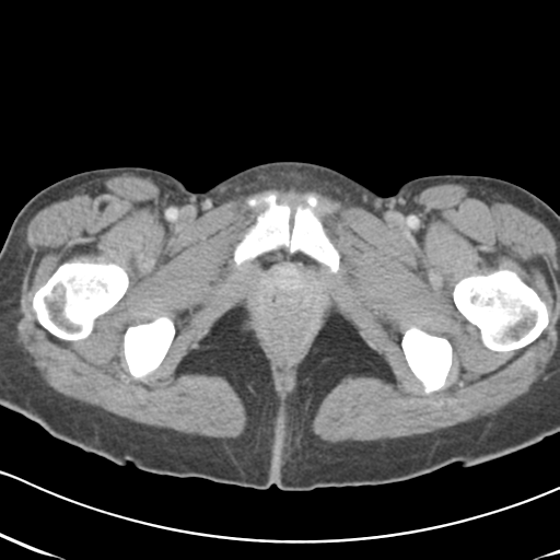 File:Abdominal desmoid tumor (Radiopaedia 41007-43740 Axial C+ portal venous phase 75).png