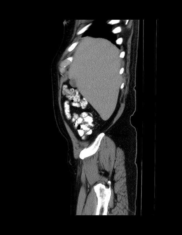 Abdominal lymphoma - with sandwich sign (Radiopaedia 53486-59492 Sagittal C+ portal venous phase 69).jpg